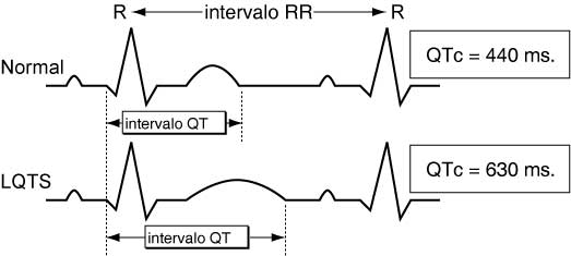 lqtsgraph-spanish.jpg